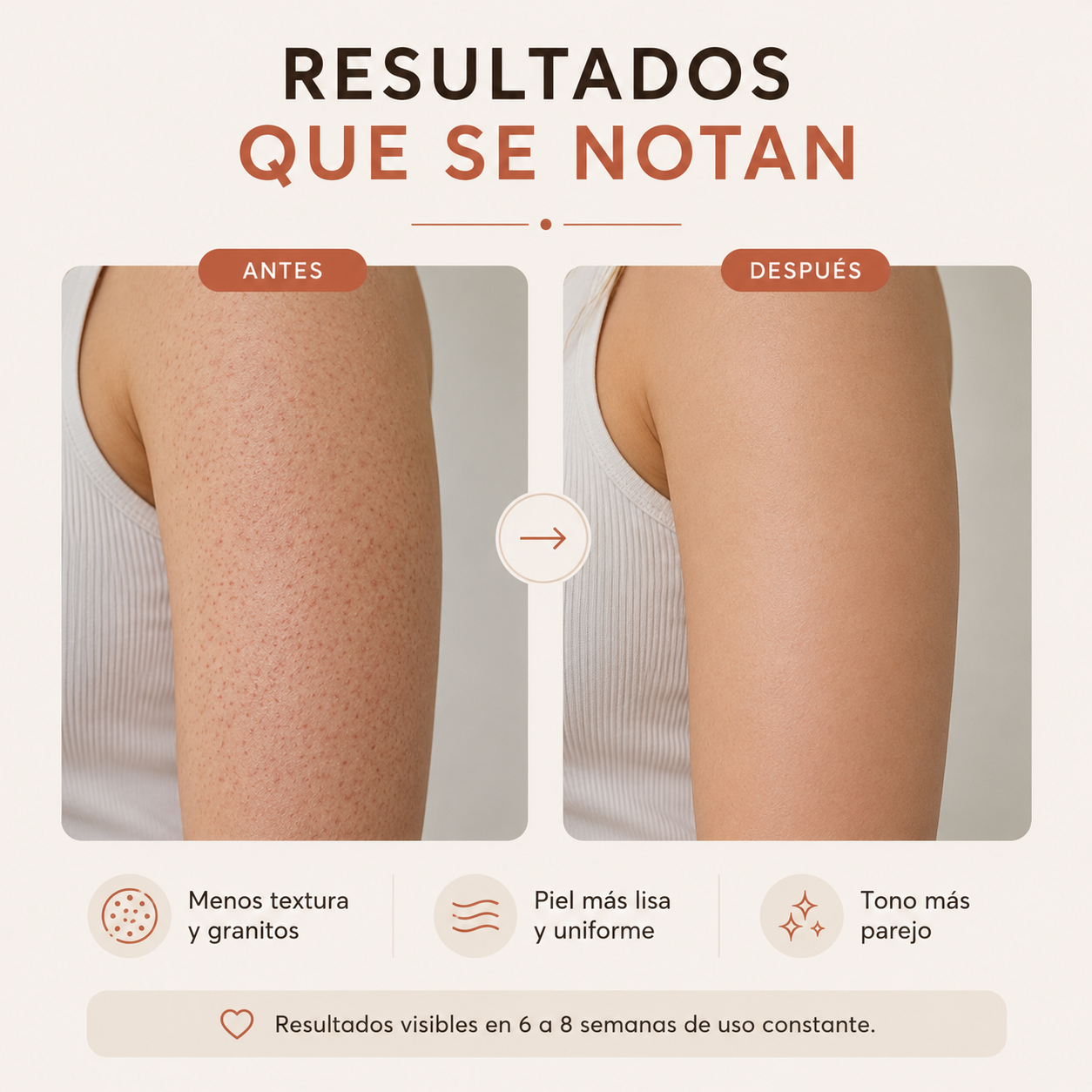 Tratamiento Para Queratosis Pilaris Avanzado